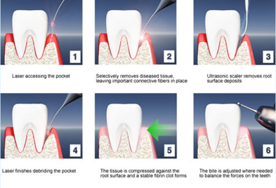 لیزر دیود دندان 980 نانومتری (2)