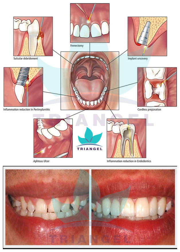 لیزر دایود دندان 980 نانومتری (8)