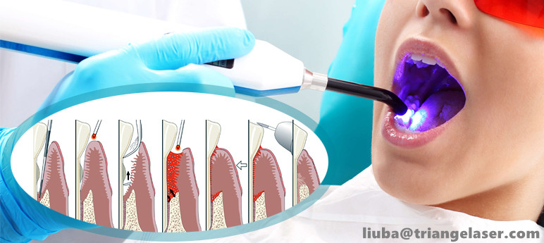 لیزر دیود دندان 980 نانومتری (9)