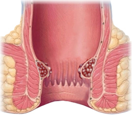 Hemorrhoids (1)