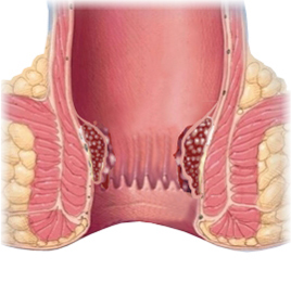 Hemorroide (2)