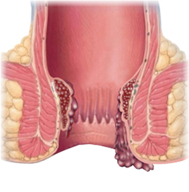 Hemorroides (3)