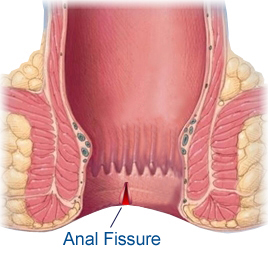 Hemorrhoids (4)