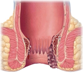 Hemorrhoids (5)