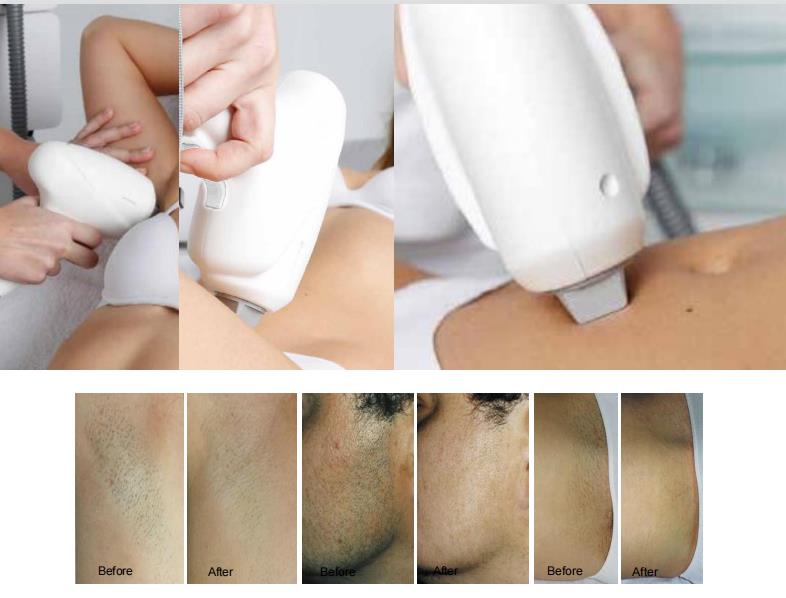 Newest Vertical Diode Laser Hair Removal Ice Laser Triple Wavelengths  808/755/1064nm Aesthetic Skin Care Equipment - China Diode Laser Hair  Removal, Hair Removal Laser