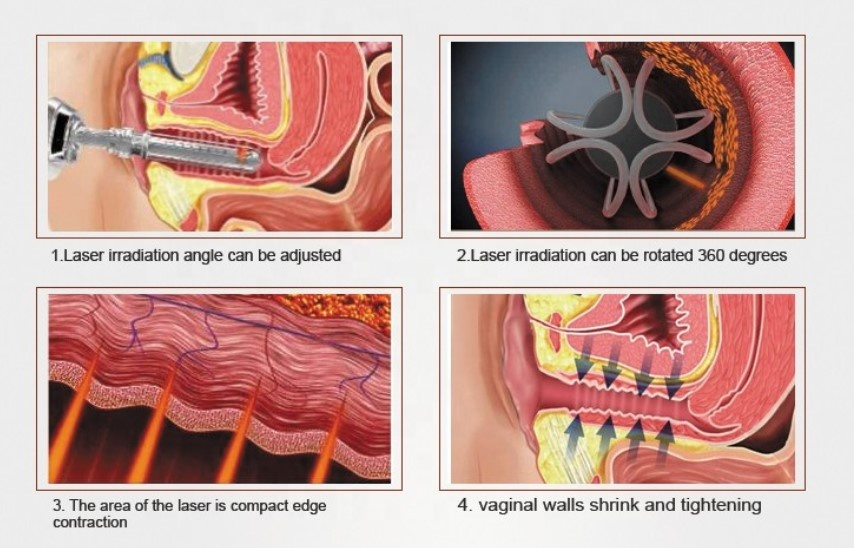 Gynecology laser-2