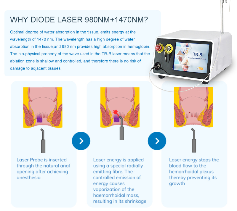 Cóireáil Hemorrhoid Léasair