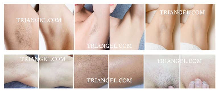 T26 808nm diode laser hair removal (2)