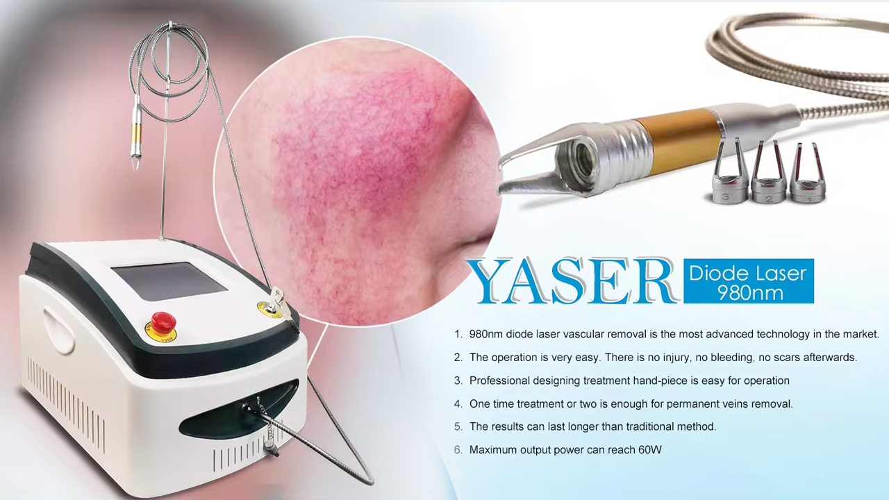 vascular laser removal